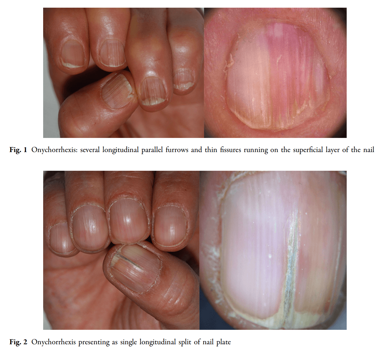 Brittle Nails hình 1 2